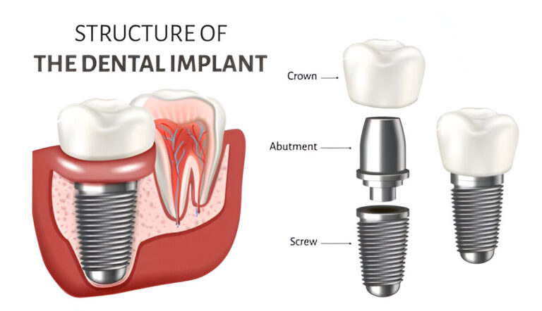 Achieving a Winning Smile: The Truth About Dental Implants Achieving a Winning Smile